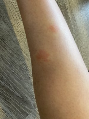 BED BUG BITES