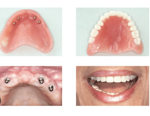 Emergency Denture Services