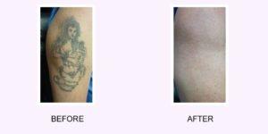 Tattoo removal