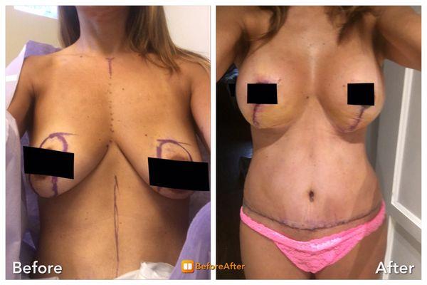 5 days post-op Tummy tuck- no drains Breast lift/aug- no drains Mommy Makeover speediest recovery ever!  Dr. Brian Reagan has skills!!