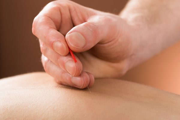 Dry needling can be an effective way to correct muscle imbalances and treat pain.