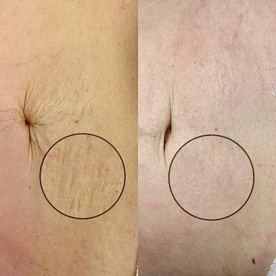 Post Pregnancy Stretch Marks - Transformation