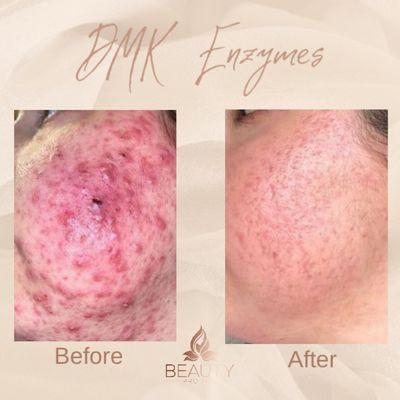 DMK enzymes therapy for acne skin.