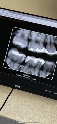 Bottom 2 teeth are were the fillings were done. Unclean work, the floss couldn't even pass through.