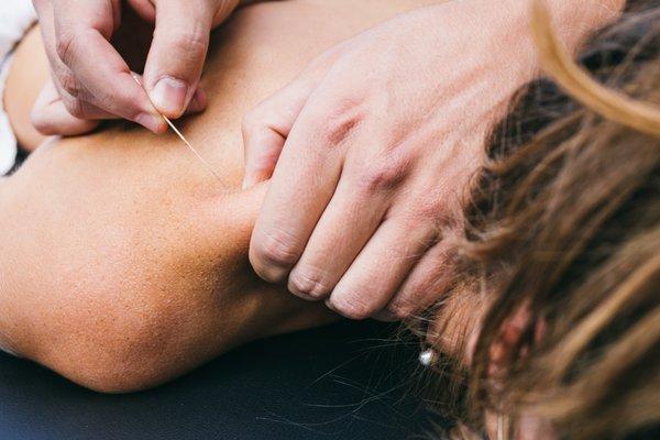 Dry Needling for Trigger Points