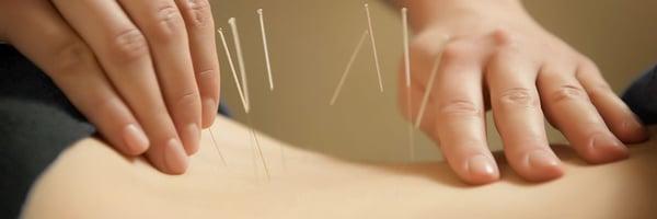 Acupuncture - Natural Way of Healing