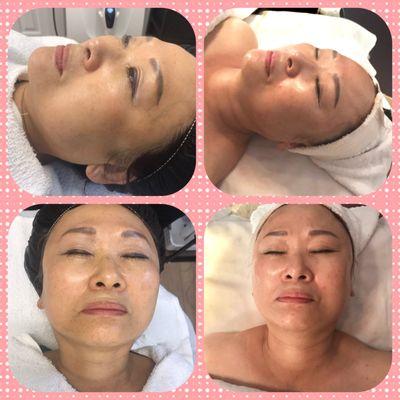 Radio Frequency Skin Lifting and Tightening.