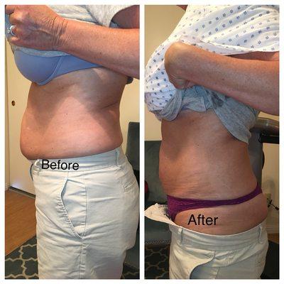 Even just one Slender Wave Cavi-Lipo painless Ultrasound treatment can make a big difference!