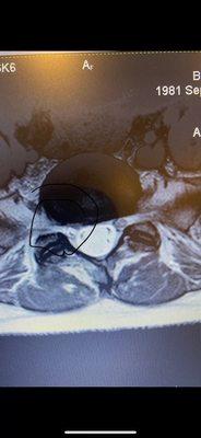 Herniated disc