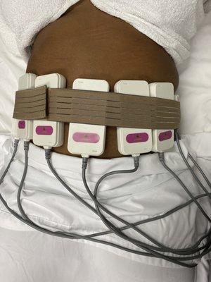 Non- invasive Laser lipo