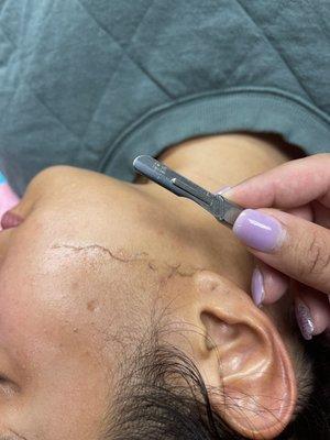 Dermaplain facial