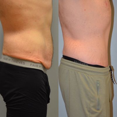 Tummy Tuck