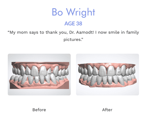 Corrected crossbite & crowding in 6 months!