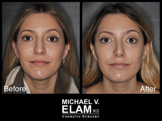 Rhinoplasty - 4 Weeks Post Op - 26 Year Old Woman