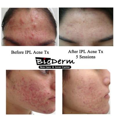 IPL Acne - Lasting, real results to help reduce acne