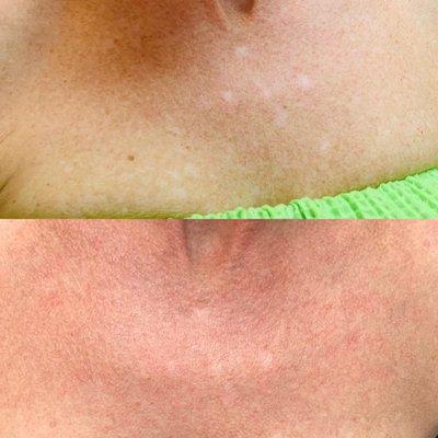 IPL Photo-Facial clears away redness and sun damage on the chest.