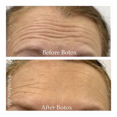 First ever Botox treatment for this patient. Seven days initial treatment.