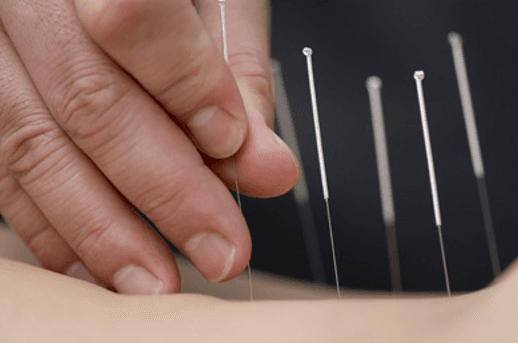 Over 20 years experience with acupuncture and dry needling!