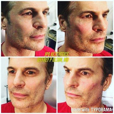 Actor/artist Thom Bierdz.  Facial sculpting