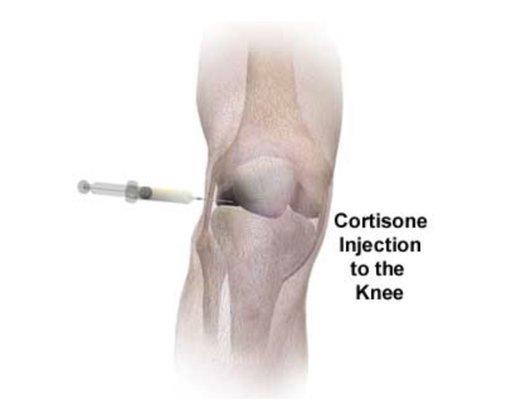 Knee Cortisone Injection