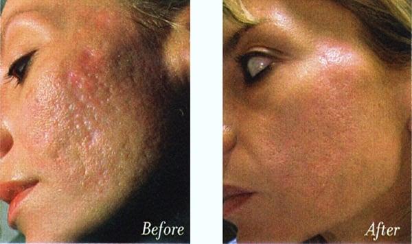 microdermabrasion helps with acne scars.