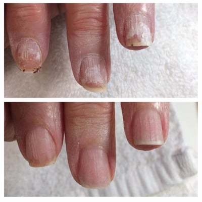 Nail Treatments (Before/After)