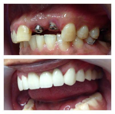 Implant surgery and restoration and cosmetic veneers and crowns