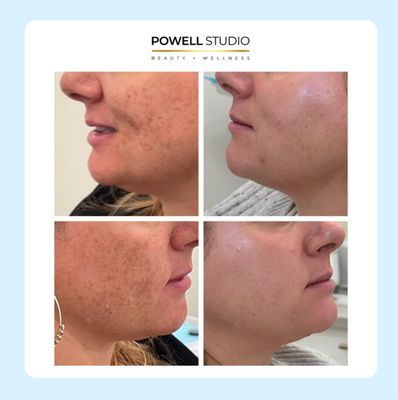 Check out these amazing before-and-after results from our ZO Bleaching and Blending hyperpigmentation program!