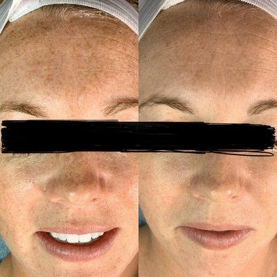 Microneedling after 2 sessions