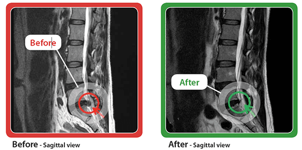 Our pre and post treatment MRIs show  Non-Surgical Spinal Decompression success at restoring herniated discs.