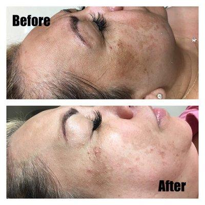 Facial Dermaplaning