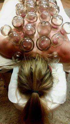 Cupping