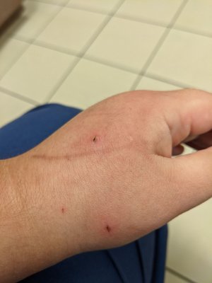 Cat bite