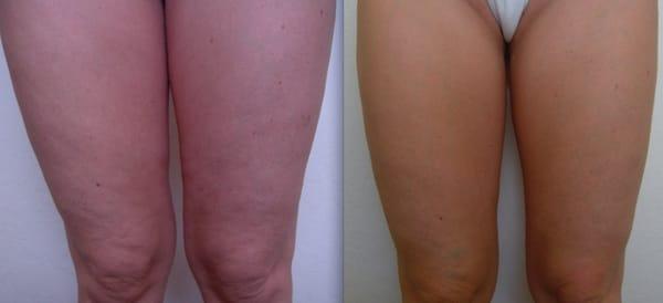 Actual Patient:  Cellulite Reduction and Body Contouring using our unique combination of VelaShape and Transdermal Iontophoresis