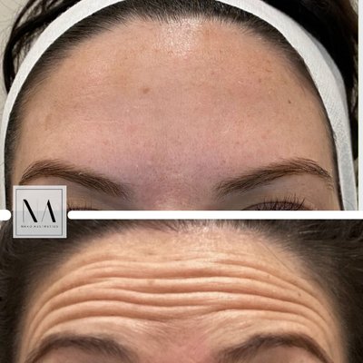 Forehead Wrinkle Relaxers