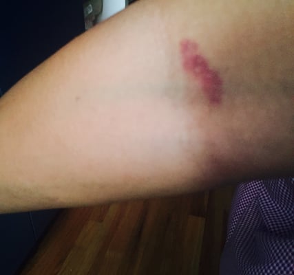 My arm two days after getting blood drawn at Dr. Cho's office. Is this normal?