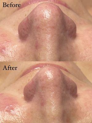 Facial before and after extractions