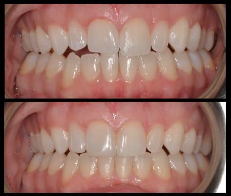 Esthetic bonding on teeth #s 7 and 8 (right central and lateral incisors).