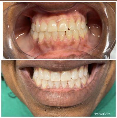 Before/After Teeth Whitening