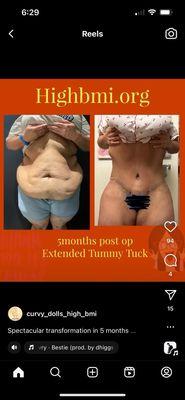 Before and after just a tummy tuck