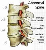 Abnormal Spine