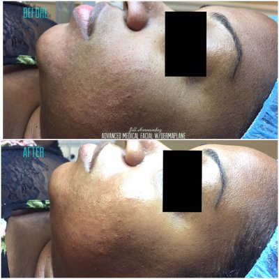 Advanced Medical Facial with Dermaplane. Preformed: by Lic Medical Aesthetic Jill Hernandez Visit our website to book your service