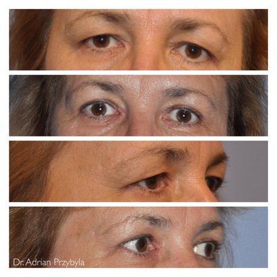 Before & after - Upper eyelid blepharoplasty (eyelid lift) - Performed by Dr. Adrian Przybyla