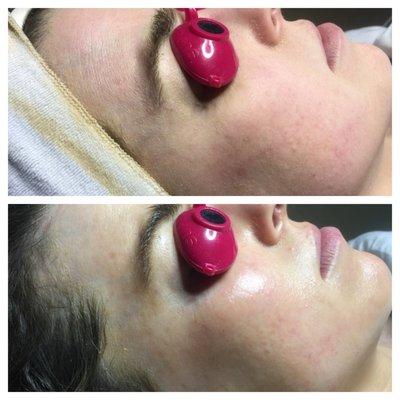 Dermaplane + oxygen Vitamin Infusion Facial