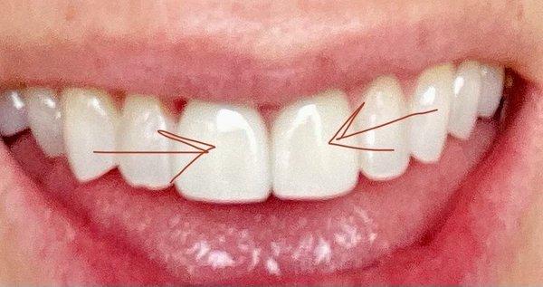 Two front veneers. Match natural teeth perfectly!