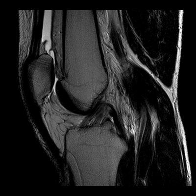 mri of the knee