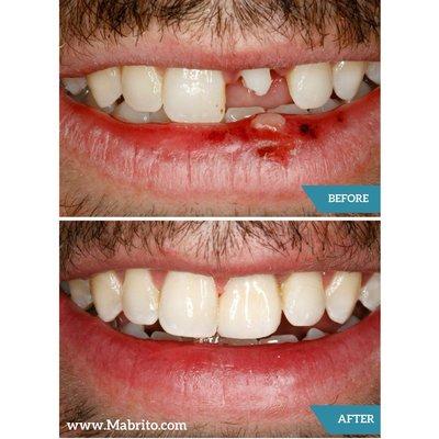 Before/After dental implant