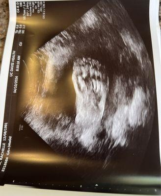 34 week ultrasound, Mirarose was thriving with an average weight & a significant amount of hair!