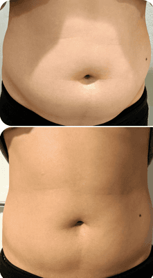 Before and 1 week After Stomach Treatment! Results continue to improve up to 1 year