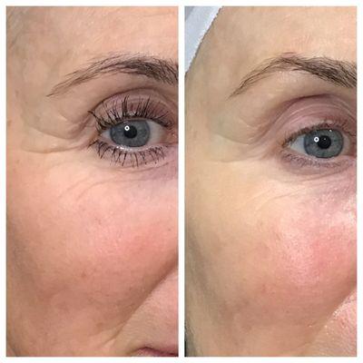 After 2 microneedling treatments, nothing else!